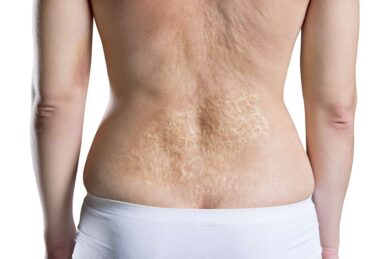 Laser Hair Removal Burns: Know the Risks