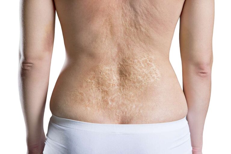Laser Hair Removal Burns: Know the Risks - Crosby Law Laser Hair Removal Burns: Know the Risks - Crosby Law